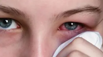 "الرمد" ينتشر في المدينة المنورة ومخاوف من انتقال العدوى في المدارس
