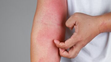 ما هي اسباب التهاب الجلد وأفضل علاج طبيعي من المنزل؟