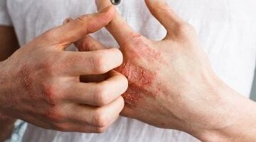 الإكزيما الجلدية.. خطوات تساعدك على الحد من تهيج البشرة